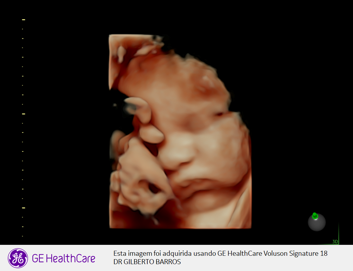 Ultrassonografia 3D de face e mão fetal realizada pelo Dr. Gilberto Barros